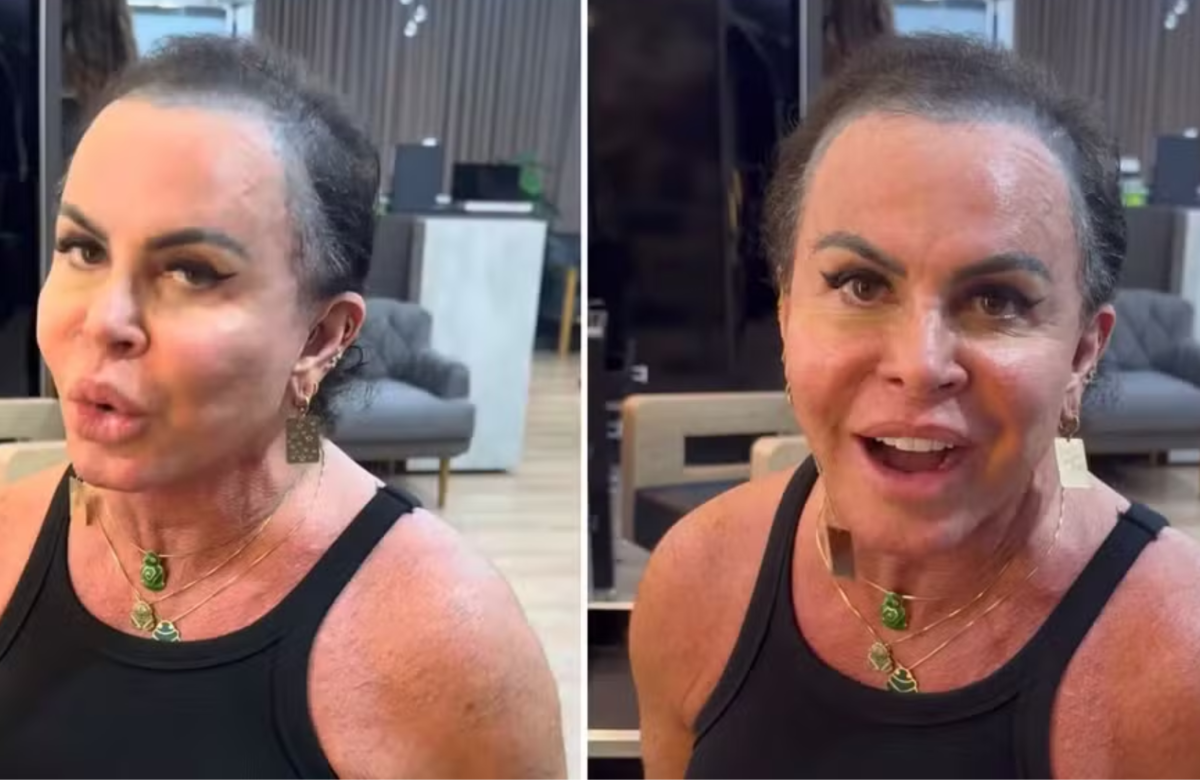 Em tratamento de alopecia, Gretchen surge sem prótese capilar na web
